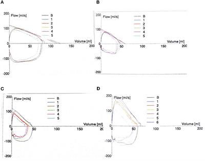 Respiratory Morbidity and Lung Function Analysis During the First 36 Months of Life in Infants With Bronchopulmonary Dysplasia (BPD)